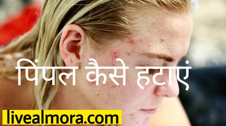 पिंपल कैसे हटाएं : इन तरीकों से चुटकियों में गायब होंगें पिंपल्स